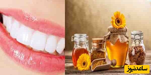 تأثیر عسل بر دندان و لثه