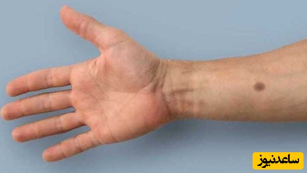 هشدار خطر سرطان با ایمپلنت