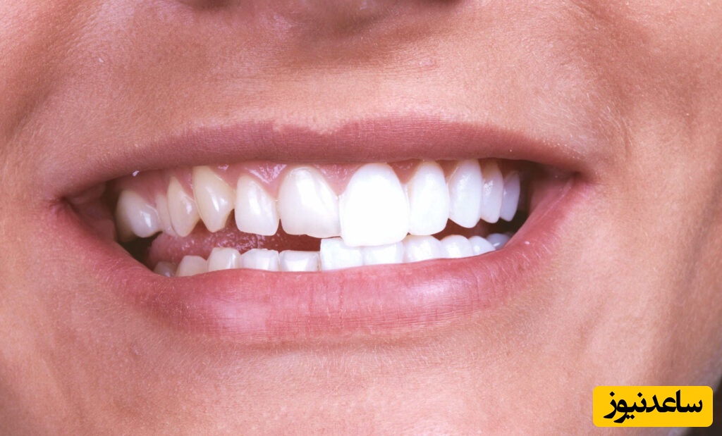 فرآیندهای زیبایی دندان