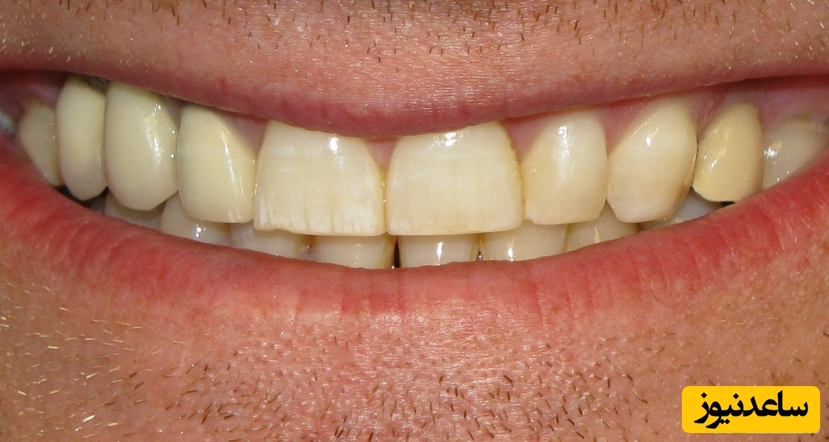 همه ی آن چه لازم است در مورد تغییر رنگ دندان بدانید!