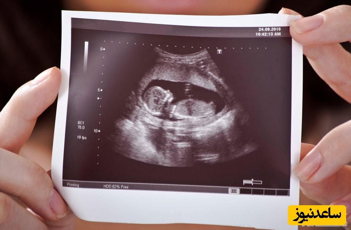 همه چیز درباره سونوگرافی تعیین جنسیت جنین