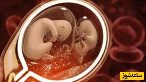 خروج یک جنین از سرِ خواهرِ زنده اش در شکم مادر +عکس سونوگرافی