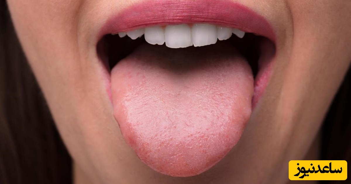 علل سوختگی زبان چیست؟