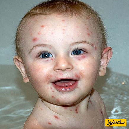 دیدن آبله در خواب چه تعبیری دارد؟ / تعبیر خواب آبله