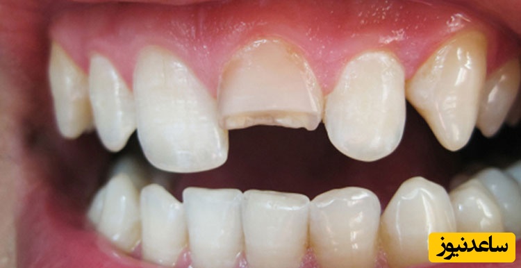 روش های مطمئن و اصولی ترمیم دندان شکسته چیست؟