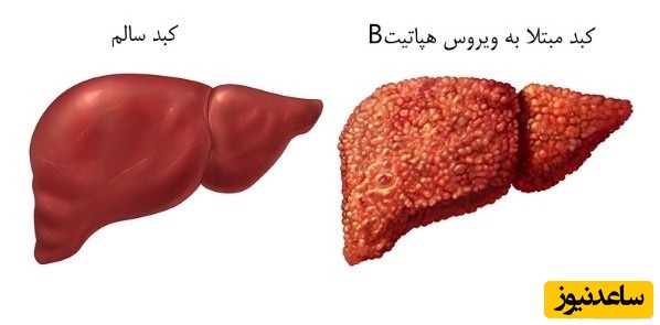 کدام هپاتیت از طریق رابطه جنسی منتقل می‌شود؟