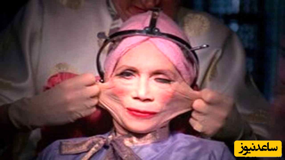 نگاهی به عجیب ترین جراحی های پلاستیک دنیا /  بلای وحشتناکی که قابل جبران نیست