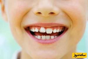 4 روش موثر برای درمان اوربایت دندان