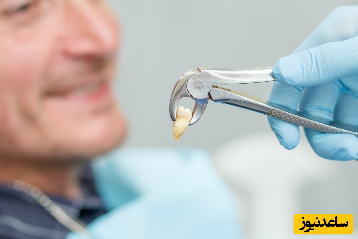 مراقبت های کشیدن دندان تا بهبودی کامل