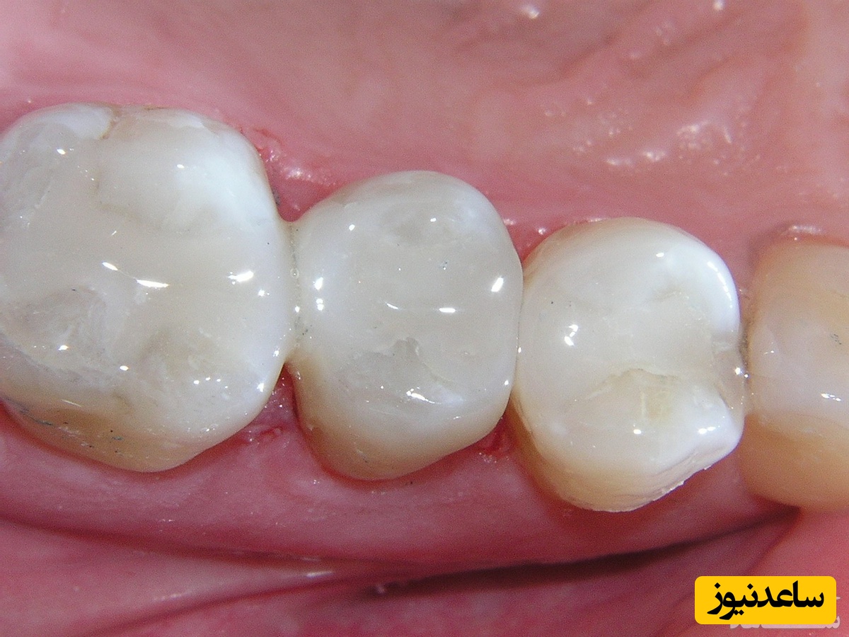 در مورد پر کردن دندان با مواد همرنگ چه می دانید؟