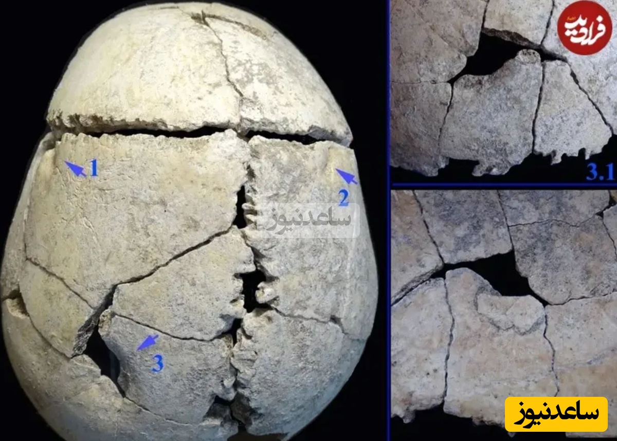 آسیبهای روی جمجمه که در اثر فرو رفتن دندان شیر به وجود آمدهاند