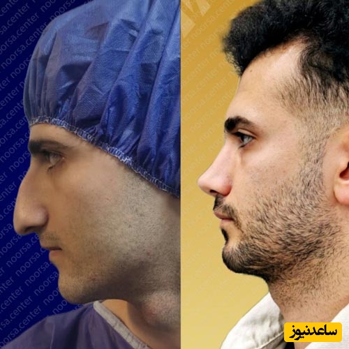 قبل و بعد از عمل بینی در کلینیک زیبایی نورسا