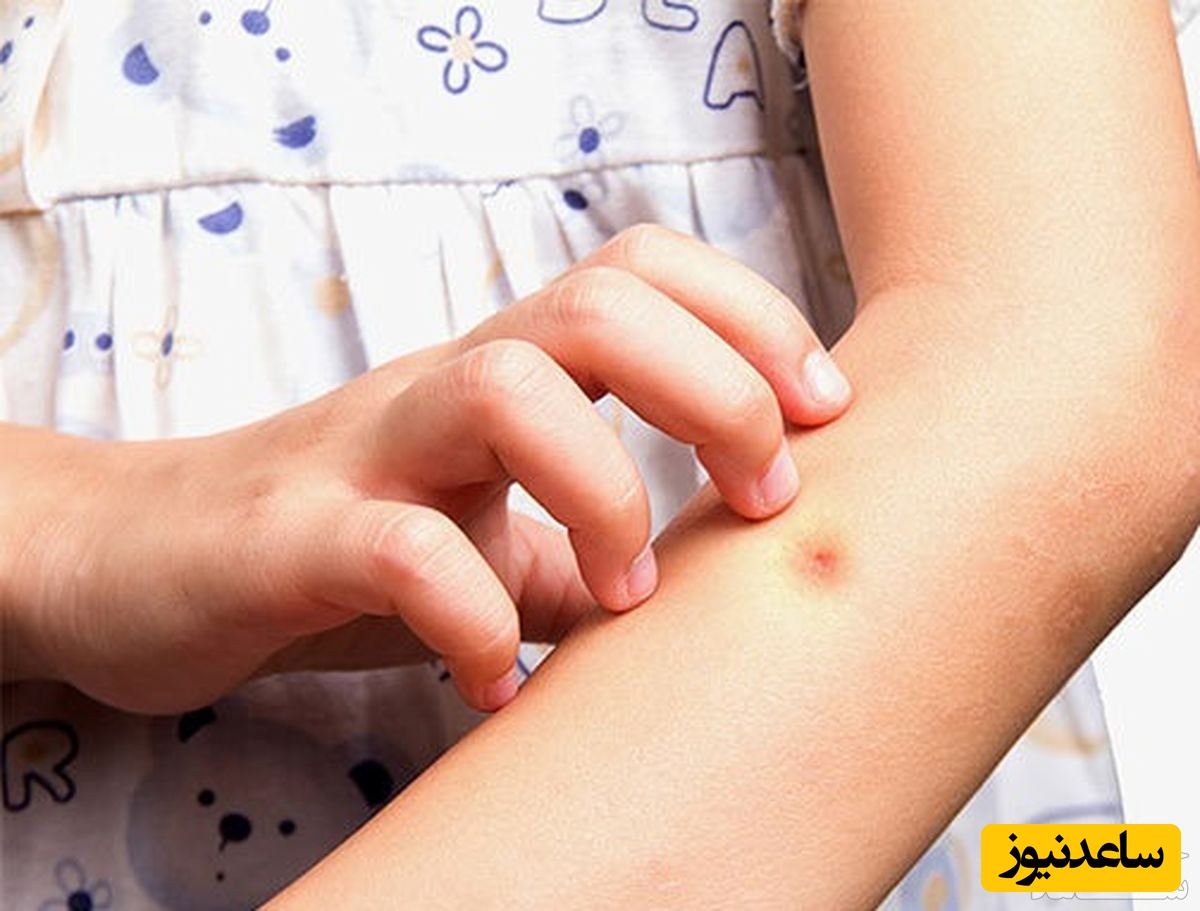 علائم نیش زدن عنکبوت در دوران بارداری و روش های درمان