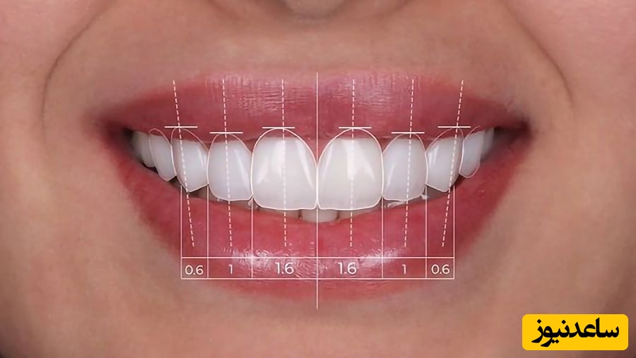 اصلاح طرح لبخند با کامپوزیت دندان