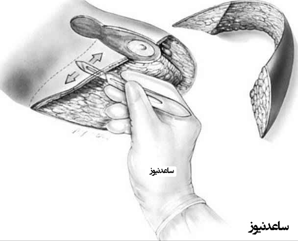 هر آنچه که باید در مورد ماموپلاستی کاهشی بدانید