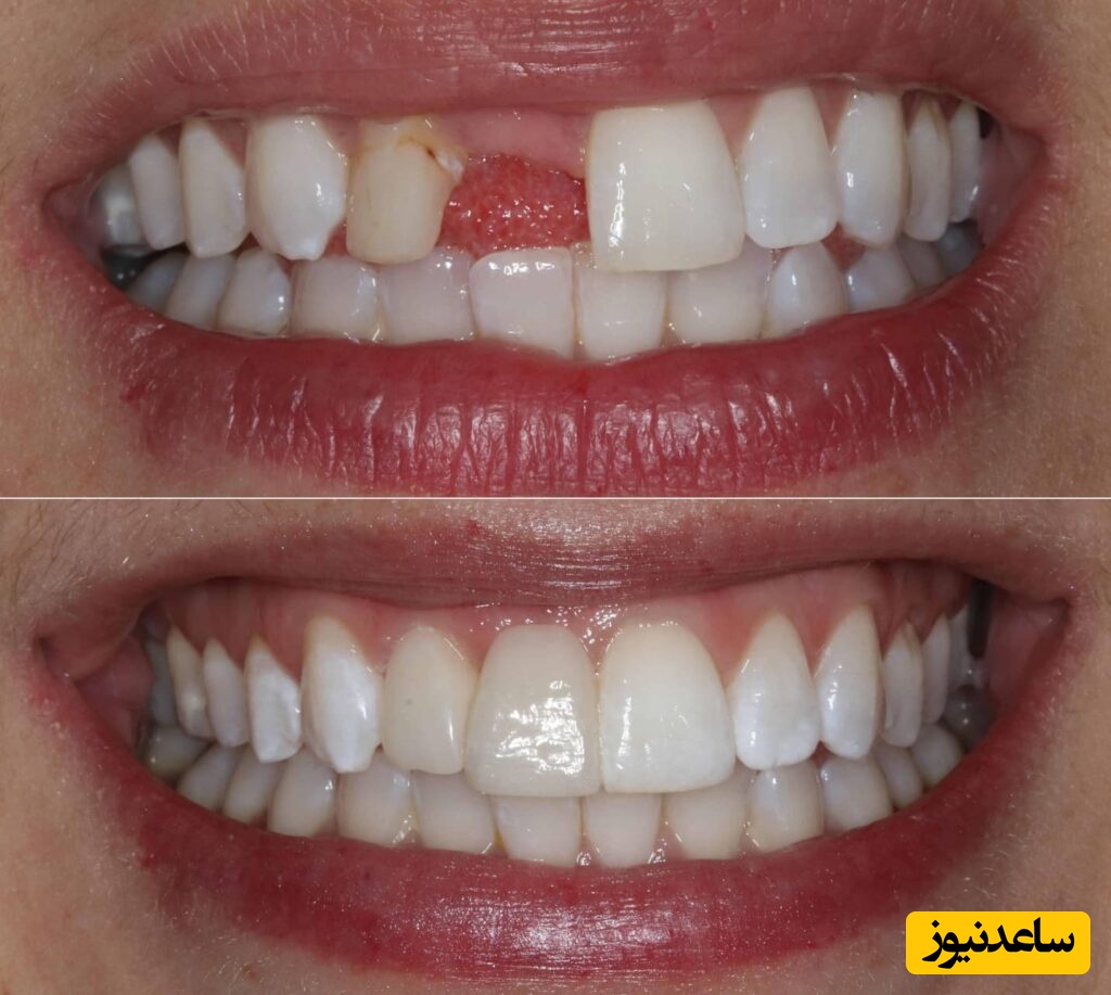 جایگزینی دندان‌های از دست رفته با بریج ثابت