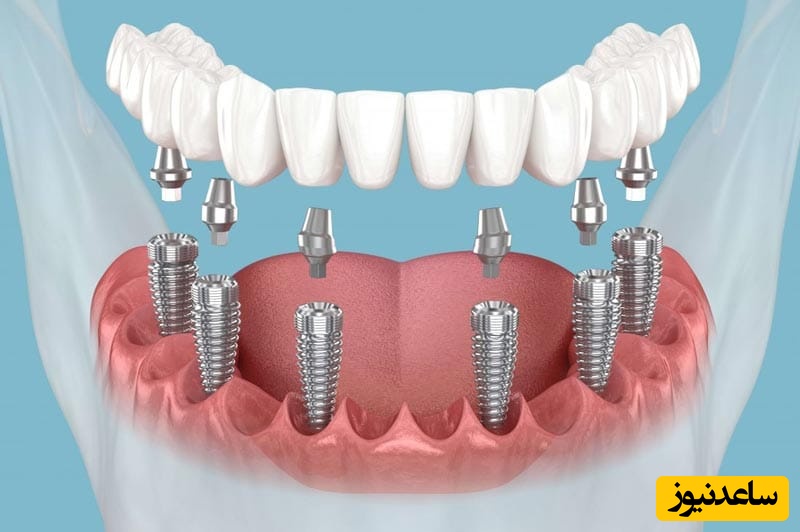 درمان ایمپلنت بعد از پس زدن چیست؟
