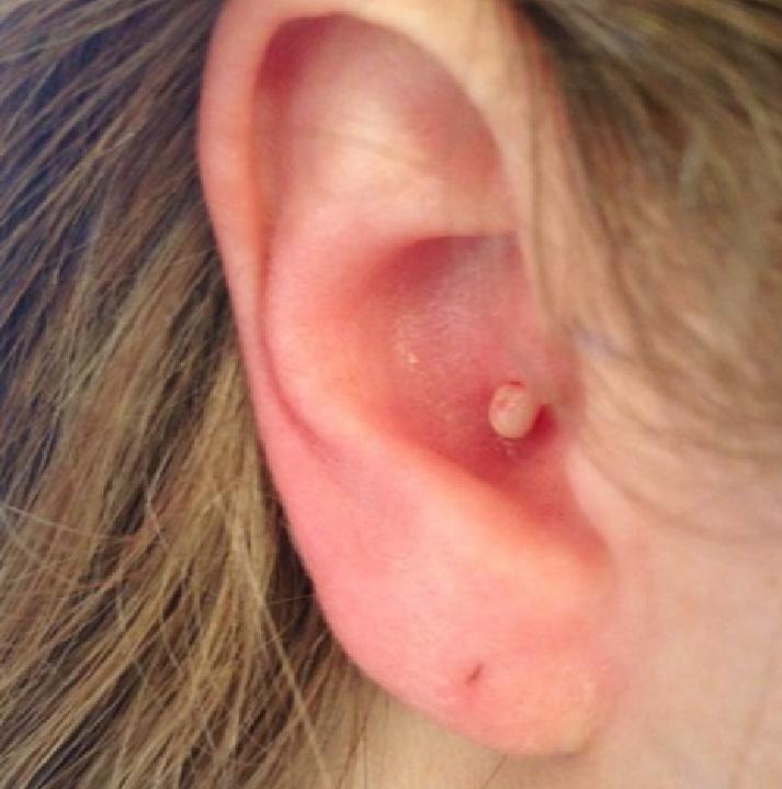 جوش کنار گوش