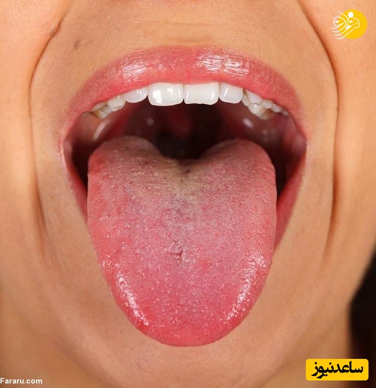 علت زخم شدن دهان چیست؟