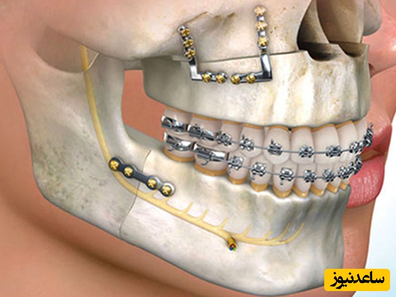 عوارض جراحی فک چیست؟