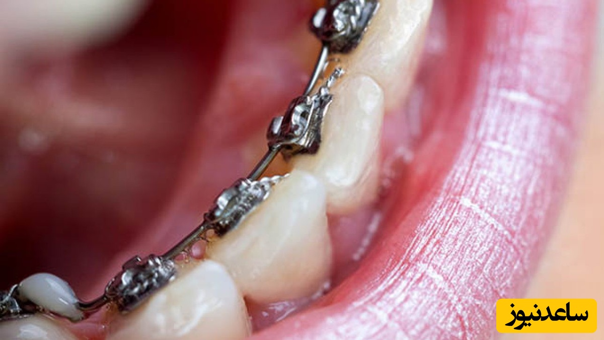 5 نکته ی مهم در مورد مراقبت از ارتودنسی