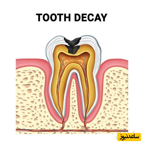 علائم پوسیدگی ریشه دندان چیست؟