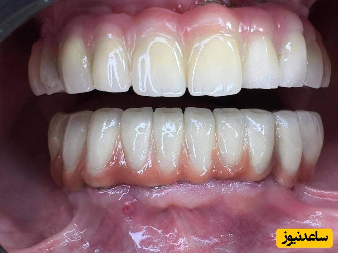 پر کننده های غیر مستقیم دندان