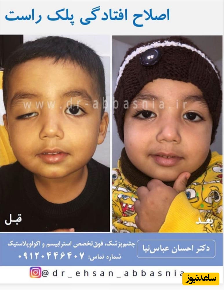 موثرترین روش درمان افتادگی پلک