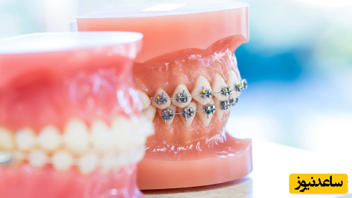 ارتودنسی کاموفلاژ چگونه عمل میکند؟