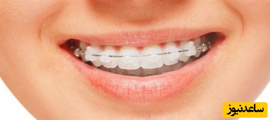 نحوه کشیدن نخ دندان برای بیماران ارتودنسی