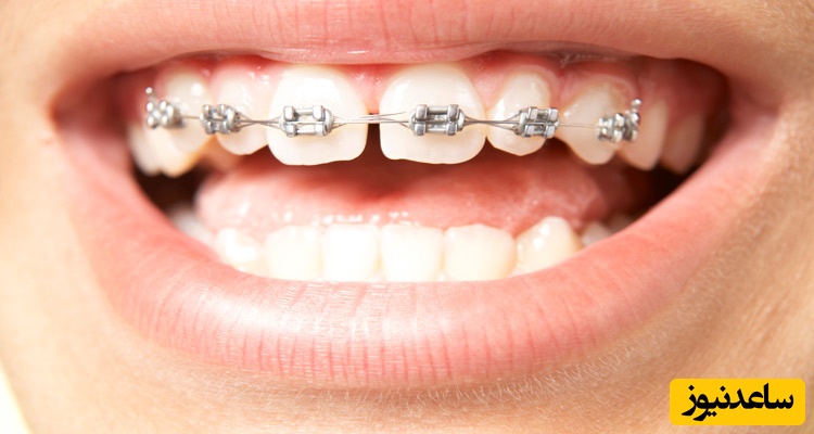 درمان فاصله بین دندان‌ها چگونه امکان پذیر است؟