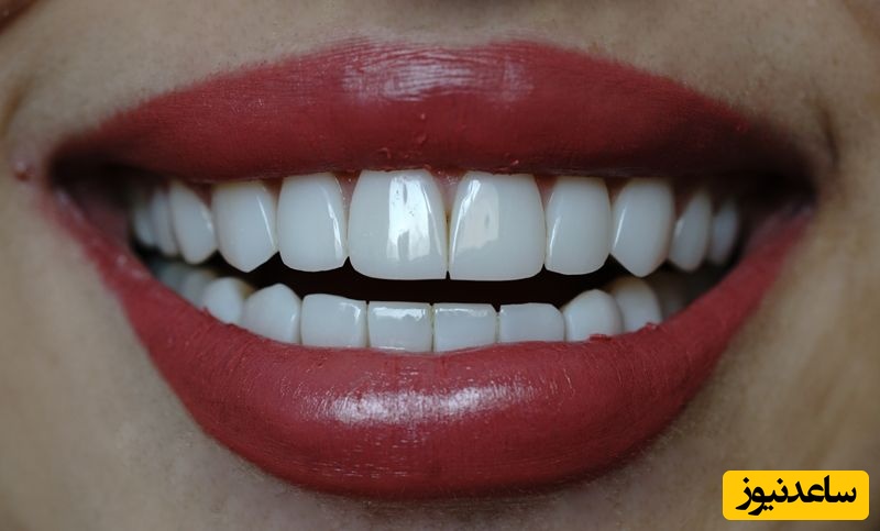 3 مورد از معایب مهم کامپوزیت ونیر دندان