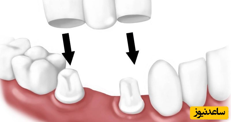 معایب و مزایا ی بریج دندان