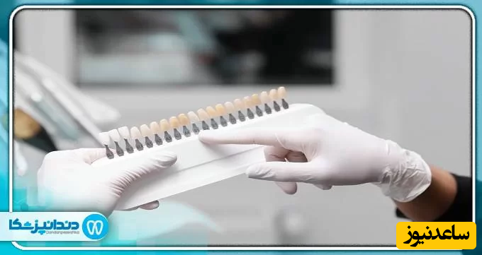 آیا لمینت باعث پوسیدگی دندان ها می شود