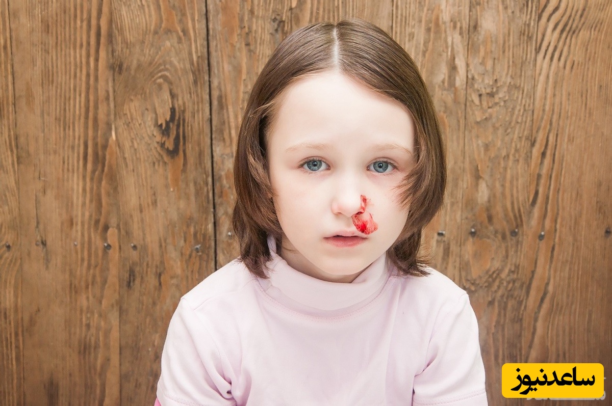علائم و نشانه های شکستگی بینی کودک چیست؟