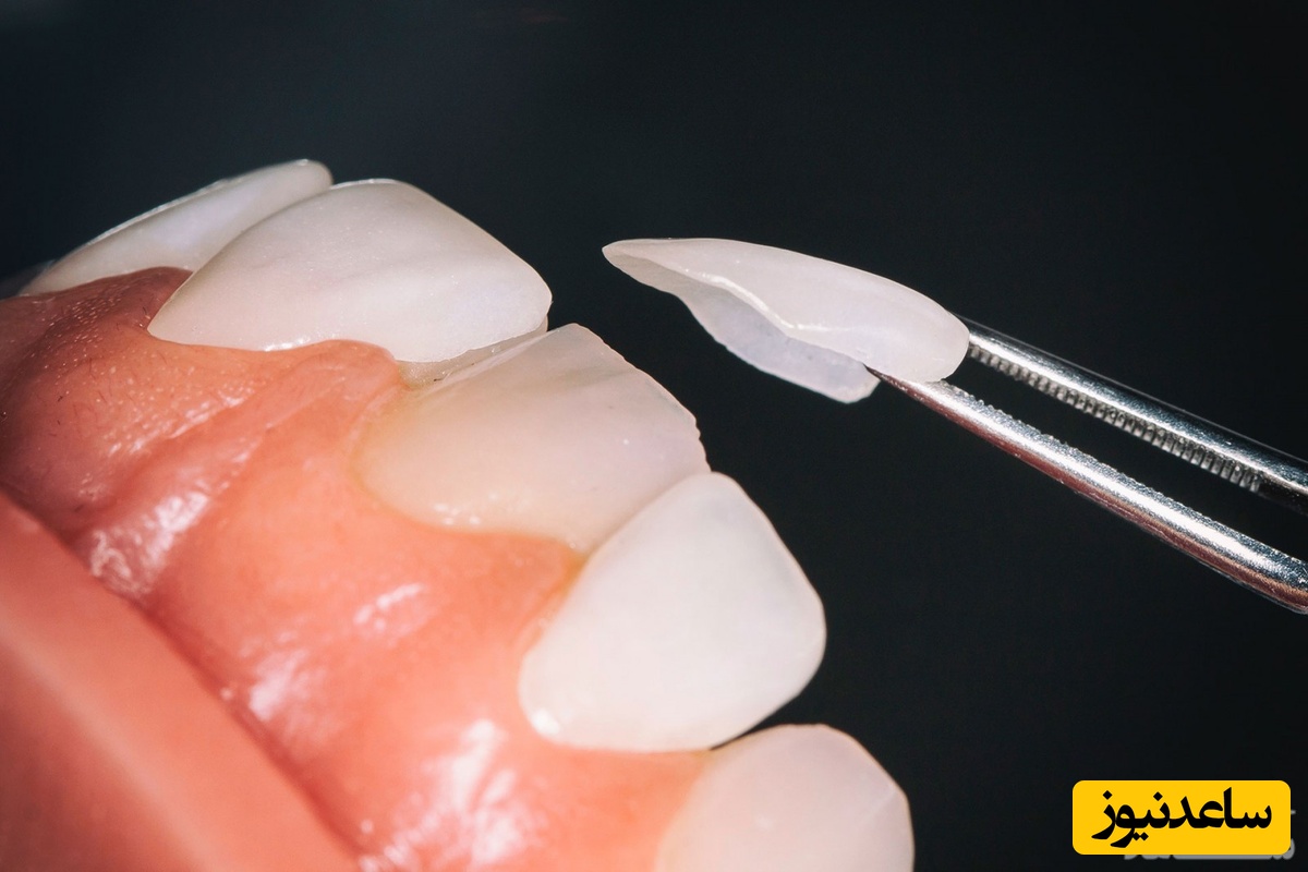 انتخاب رنگ و شکل لمینت دندان