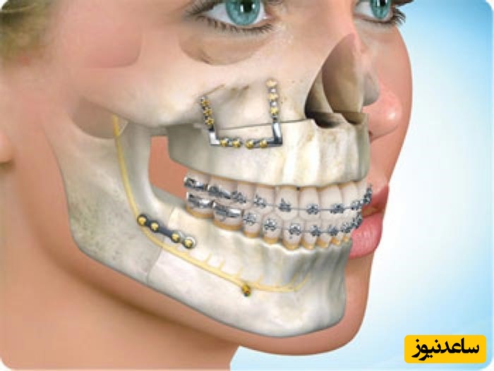 عوارض جلو زدگی فک بالا چیست؟
