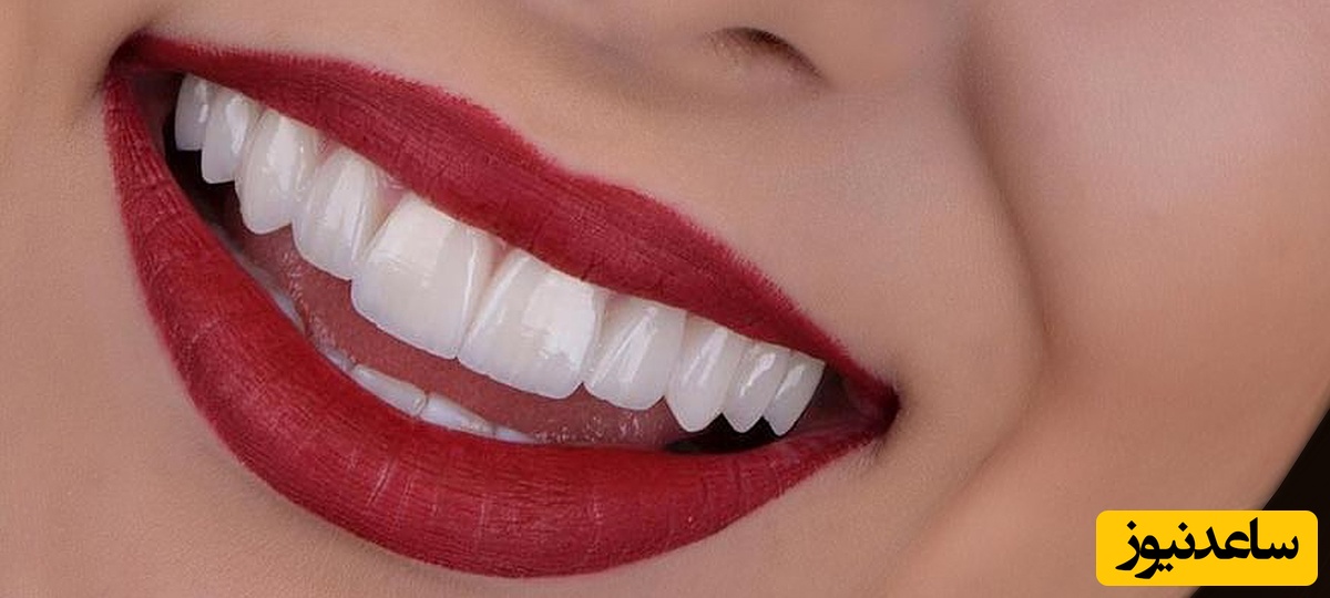 سوالات متداول در مورد کامپوزیت دندان