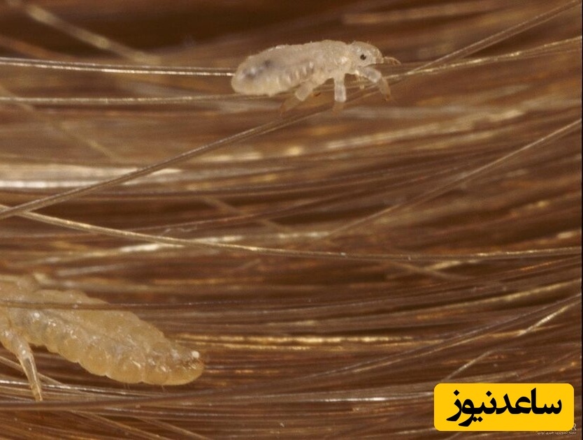 هر آنچه که باید خانواده ها در مورد شپش بدانند!