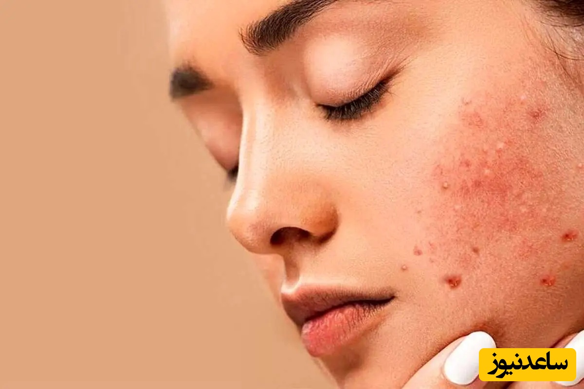 چگونه آکنه های دوران نوجوانی را درمان کنیم؟
