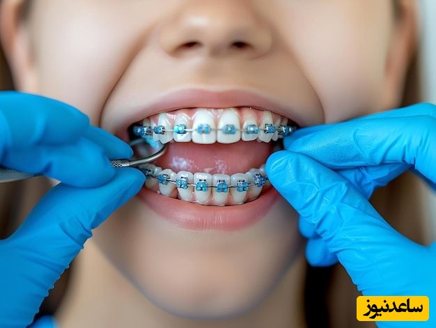 روش های محافظت از ارتودنسی دندان هنگام ورزش