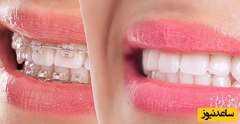 تاثیر ارتودنسی بر زیبایی چهره