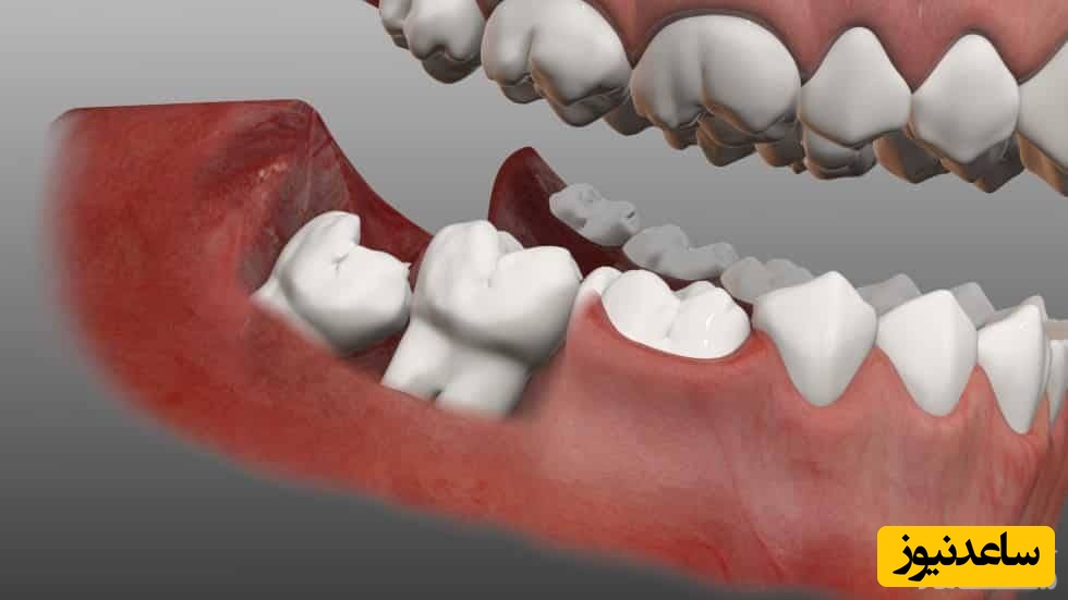 قبل از کشیدن دندان عقل بخوانید!