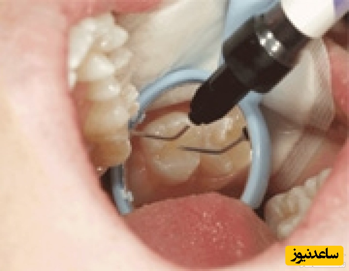 شیار پوشی دندان چگونه می باشد؟