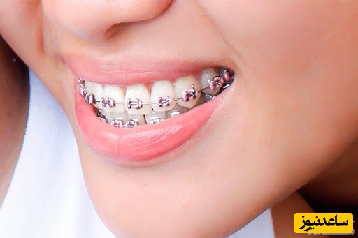 بهترین سن برای انجام ارتودنسی