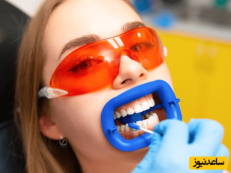 بلیچینگ دندان ها و نکاتی که باید بدانید!