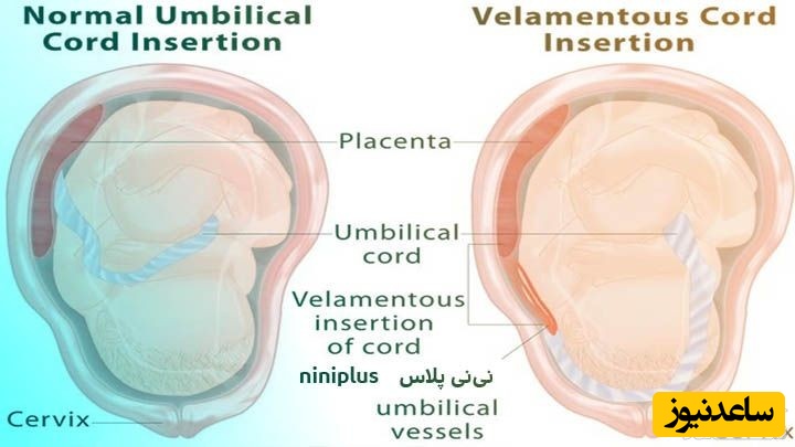 مشکلات و اختلالات بند ناف جنین