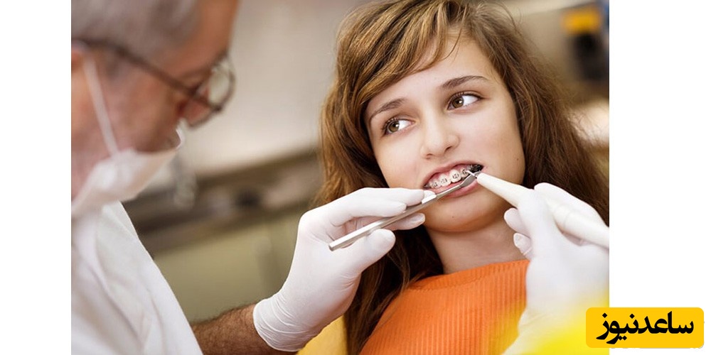 انواع بریس های دندان در ارتودنسی متحرک