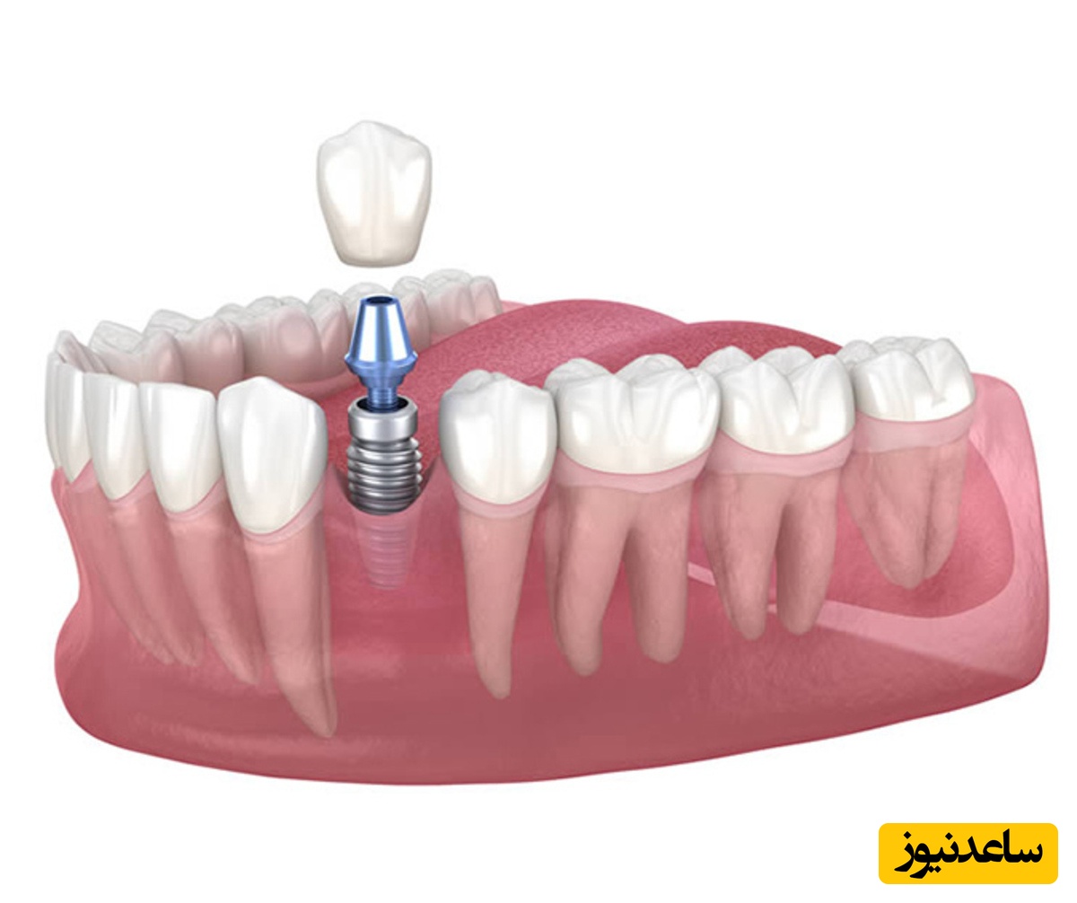 چه عاملی باعث شکست درمان ایمپلنت می‌شود؟