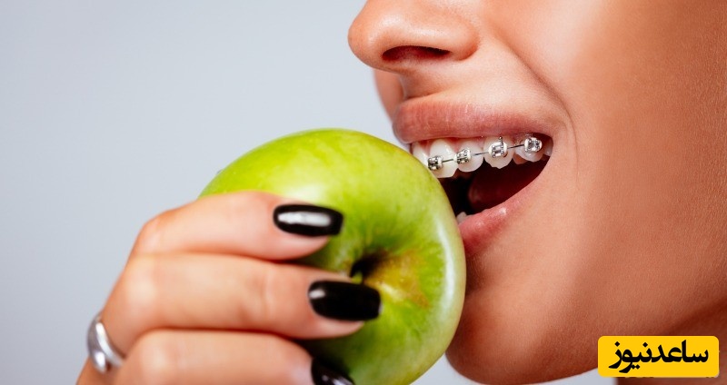 چرا و چگونه از ارتودنسی ثابت خود نگهداری کنیم؟